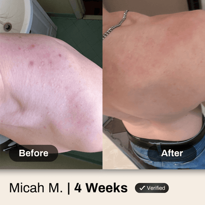 Shield Body Acne Wash